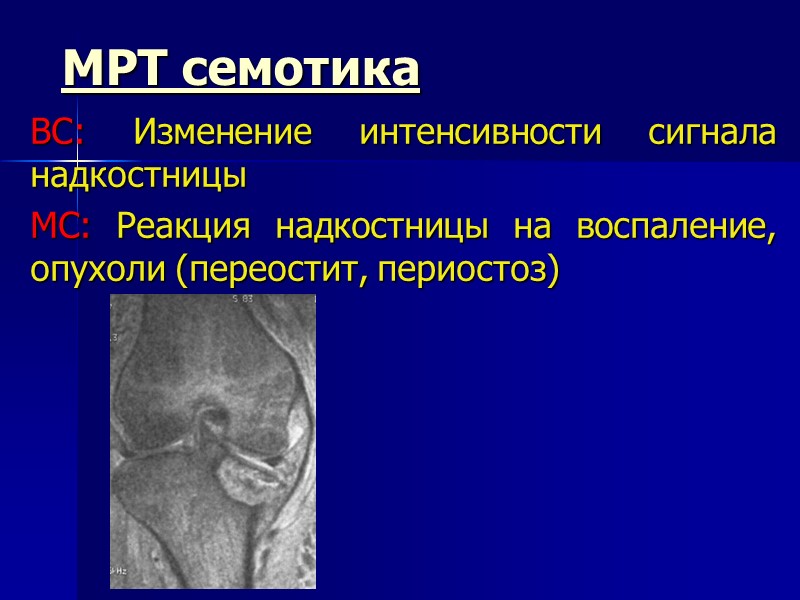 МРТ семотика ВС: Изменение интенсивности сигнала надкостницы МС: Реакция надкостницы на воспаление, опухоли (переостит,